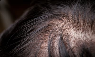 Hair Loss